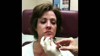 Botox for chin by Dr Elizabeth Rostan Charlotte NC dermatologist [upl. by Boggs]