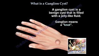 How do you treat ganglion cysts  Augusta Kluk MD Orthopedic hand surgery  UCHealth [upl. by Ahsekat]