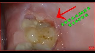 Wisdom tooth with inflamed tissue at the back pericoronitis [upl. by Thane]