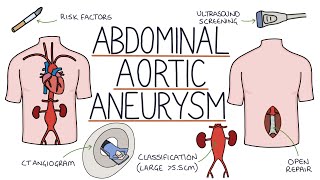 Understanding Abdominal Aortic Aneurysms [upl. by Sherer]