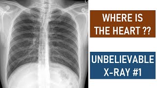 The gastrocardiac syndrome  heart palpitations caused by the stomach [upl. by Esekram]