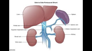 Portocaval Shunt Surgical procedure  Definition Types Indications Benefits complications [upl. by Macmillan655]