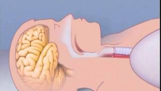 What Is Sleep Apnea [upl. by Strader]