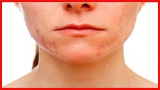 Acne conglobata causas e sintomas [upl. by Ayota644]