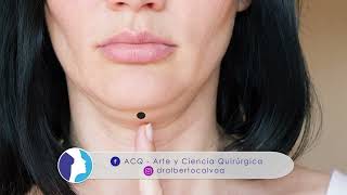 REJUVENECER el cuello FLÁCIDO y ARRUGADO ❤️ CERVICOPLASTÍA 🧣 LIFTING de CUELLO ⭐ Dr ALBERTO CALVO [upl. by Elfrida931]