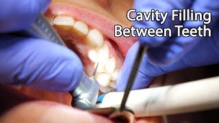 Dentist Filling A Cavity Between Teeth [upl. by Leirvag]