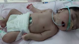 Case 691 visual initial newborn assessment dysmorphic baby Edward syndrometrisomy 18clenched hand [upl. by Husein]