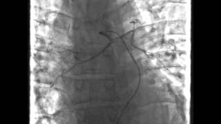 Embolisering af bronchiale arterier [upl. by Henriette]