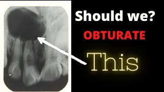 Should we Obturate tooth with periapical Radiolucency Dental ji [upl. by Lemrac]