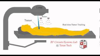 Radiotherapy with Tumor Tracking [upl. by Ithsav245]