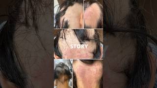 Alopecia areata therapy  Dr Soheil Beitollahalakbar [upl. by Ashling]