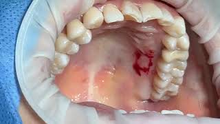 Injerto gingival libre para aumento de tejido queratinizado previo a ortodoncia [upl. by Eireva]