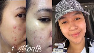 How to use Retinol for Acne  Vitamin A cream  Acretin 05 [upl. by Spitzer]