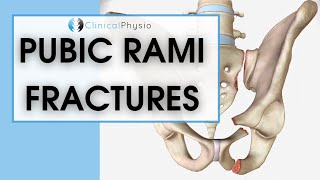 Pubic Rami Fractures  What are they How do you treat them [upl. by Aicilaana]