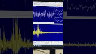 Dive bomber sound in EMGclassically seen during EMG needle insertion in myotonic dystrophy patients [upl. by Netsirt726]