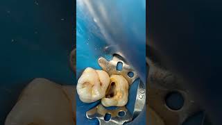 Molar 🦷 root canal treatment dentist dental dentalprocedure [upl. by Ikairik163]