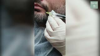 Scalp and Beard injection technique with Pluryal Hair Density [upl. by Lustick298]