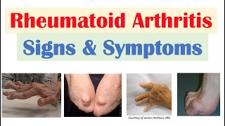 Rheumatoid Arthritis RA Signs amp Symptoms amp Associated Complications [upl. by Aicylla]