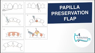 PAPILLA PRESERVATION FLAP PERIODONTAL FLAP SURGICAL TECHNIQUE DR ANKITA KOTECHA [upl. by Reinnej120]