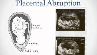 Vaginal Bleeding in Pregnancy  USMLE Step 2 Review [upl. by Palma]