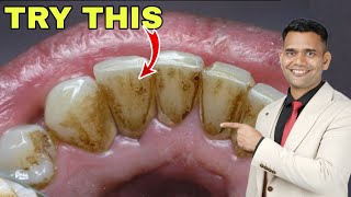 1 Simple Home Remedy For Yellow Teeth Dental Plaque Cavities [upl. by Sue852]