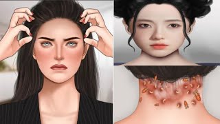 ASMR Big Flakes Dandruff amp Head Lice Removal  Satisfying Scalp Treatment  Mengs Stop Motion [upl. by Jany201]