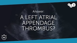 60 Seconds of Echo Teaching Answer A left atrial appendage thrombus [upl. by Sivatnod]