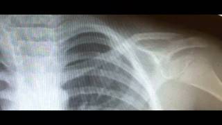 Clavicle Fracture Xray Findings and Treatment [upl. by Kaine]