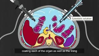 Pressurized Intraperitoneal Aerosol Chemotherapy PIPAC  Peritoneal Carcinomatosis Patients [upl. by Duky659]