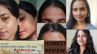 Azelaic Acid Cream 10  Aziderm Cream  Honest Review  Remove Pigmentation  Acne  Dark Sports [upl. by Acisse]