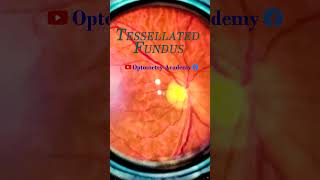 Tessellated Fundus  Indirect Ophthalmoscopy  Smartphone Fundus Videography  Short Video 58 [upl. by Ofilia]