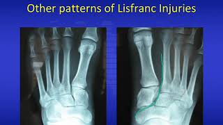 Lisfranc injuries 2020 [upl. by Alegna]