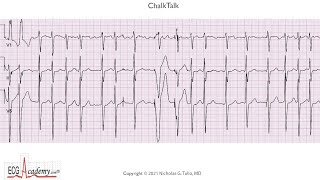 ECG Lesson in Advanced Pacemaker Troubleshooting [upl. by Llerrah]