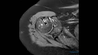 Subcoracoid impingement in 60 year old [upl. by Harlin]