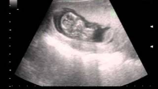 pregnancy ultrasound second month [upl. by Prisilla771]