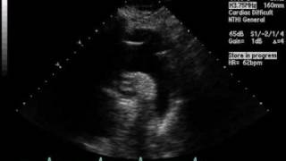 Thrombus in Right Pulmonary Artery [upl. by Wilburn]