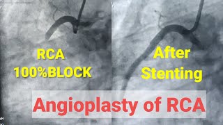 Primary Angioplasty of RCA Stenting of RCA 100 blcoked RCA [upl. by Euginom]