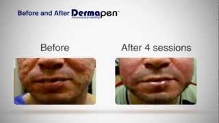 MicroNeedling Before and After  Dermapen® Treatment [upl. by Wagner]