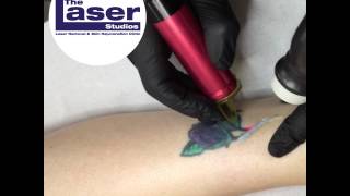 Excellent response to the first session of Laser Tattoo Removal with the Alex Trivantage [upl. by Boyt]