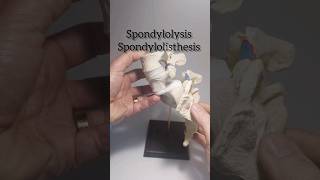 Spondylolysis Spondylolisthesis Dynamic Disc Designs Model [upl. by Ramey450]