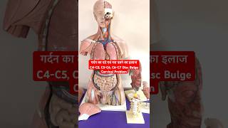 Whatsapp Number7987128051for treatment Cervical Pain गर्दन के दर्द का ईलाज C4C5C6C7 Disc bulge [upl. by Annat]