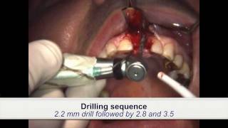 Dental Implant Placement in patient treated with iv bisphosphonates [upl. by Emorej]