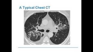 Management Strategies for Sarcoidosis [upl. by Yrred865]