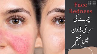 Face Redness Treatment  Face Redness Treatment at home  Chery ki surkhi kaisy khatam karein urdu [upl. by Krischer948]