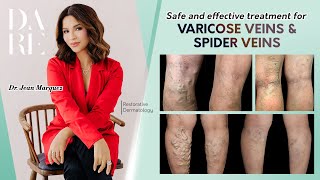 Varicose Veins Treatment Foaming Sclerotherapy [upl. by Laux896]