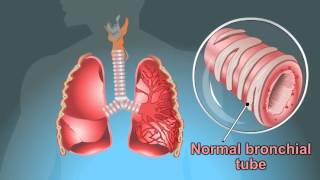 what are the Symptoms Of Tuberculosis [upl. by Thurman496]