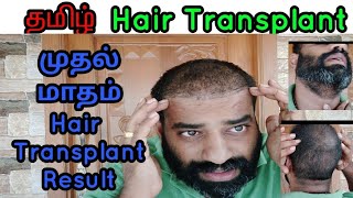 1st Month Hair Transplant Update HSN Hair Transplant ClinicTamil Hair Transplant [upl. by Yendys719]