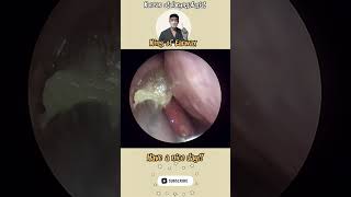 귀지형 콧물 부비동염 축농증 비염 코청소 이비인후과 rhinorrhea rhinitis sinusitis asmr ENT ENTdoctor [upl. by Smailliw]