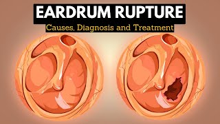 The Science Behind Eardrum Rupture Explained in Simple Terms [upl. by Nillek]