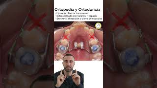 Ortodoncia y Ortopedia 👉🏼 Hyrax 💀↔️🦷 Brackets [upl. by Rochemont]